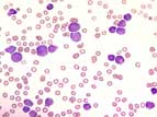 Leukemia