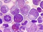 Leukemia