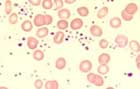 myeloproliferative