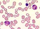 Eosinophilia